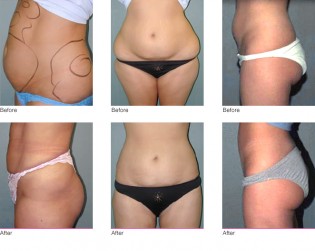 What is Liposuction?