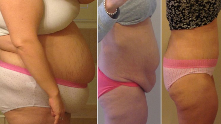 Tummy Tuck After Weight Loss