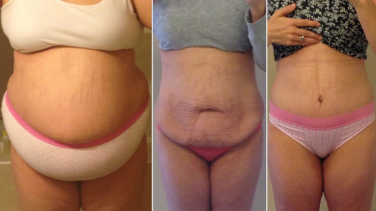 Tummy Tuck After Weight Loss