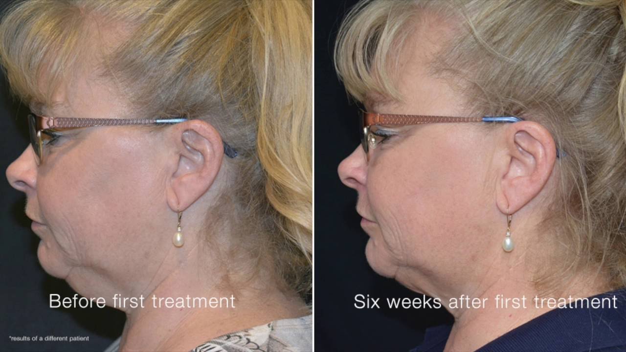 CoolSculpting for Double Chin