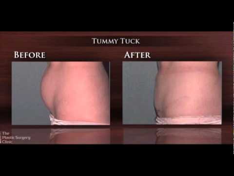 Tummy Tuck & Liposuction