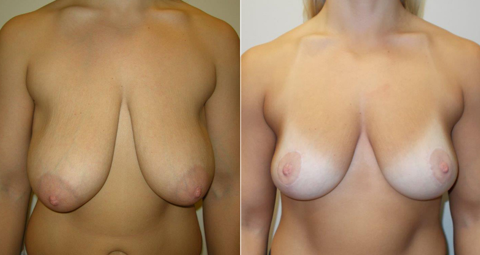 Breast Lift before and after