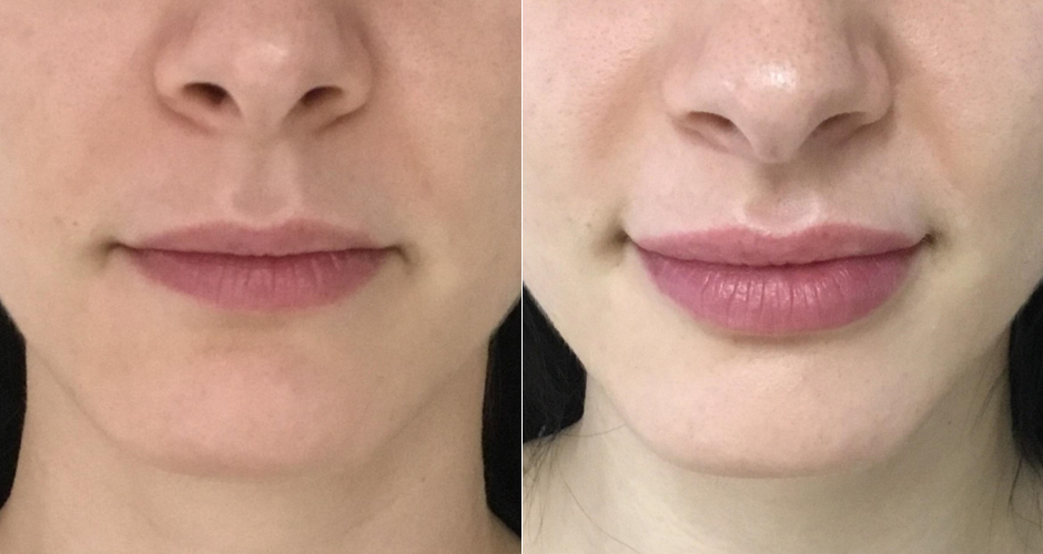 Lip Injection Before and After