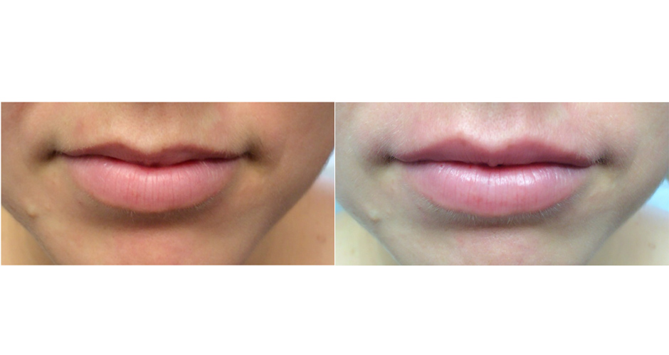 Lip Injections Before and After