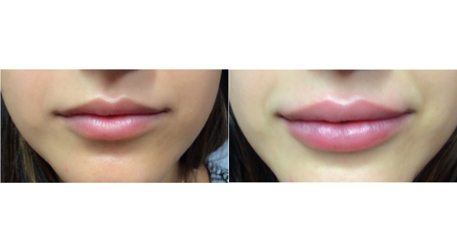 Lip Injections Before and After