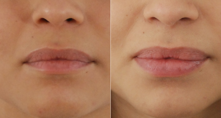 Lip Injection Before and After