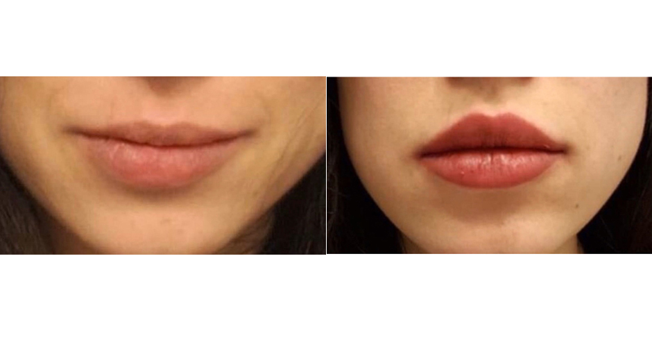 Lip Injection Before and After