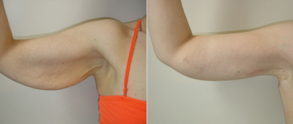 Arm Lift Before & After Photo