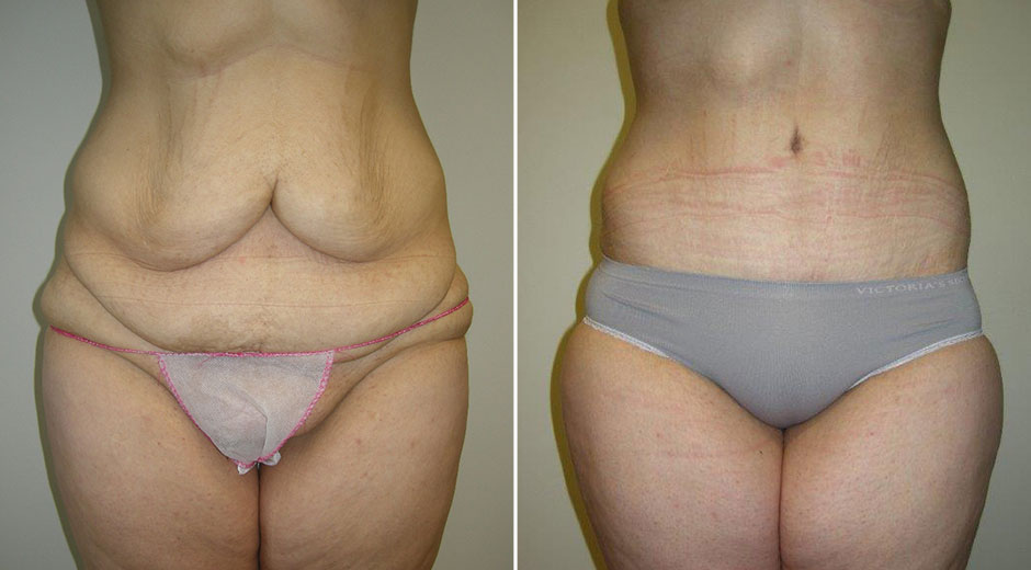 Body Contouring Before & After Photo