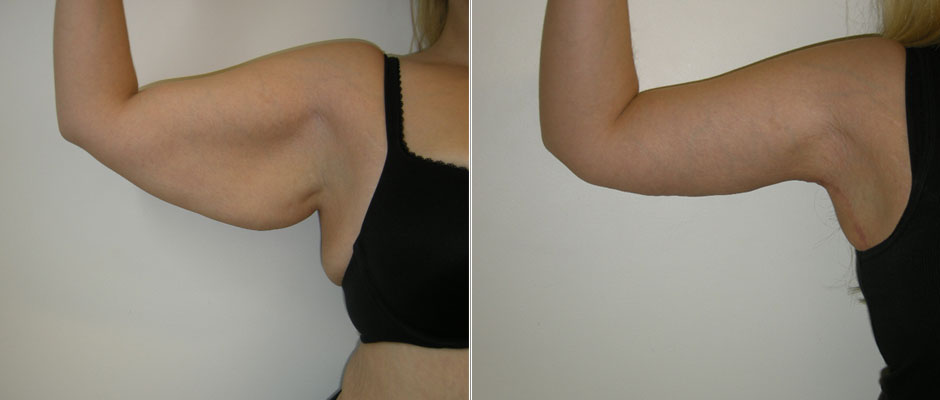 Body Contouring Before & After Photo