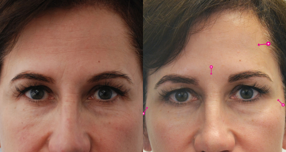 Injections for Wrinkles Before & After Photo