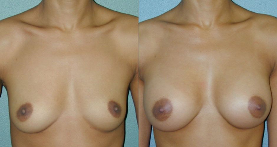 Breast Augmentation Before & After Photo