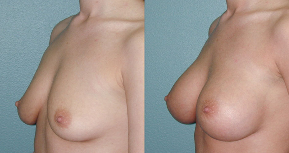 Breast Augmentation Before & After Photo