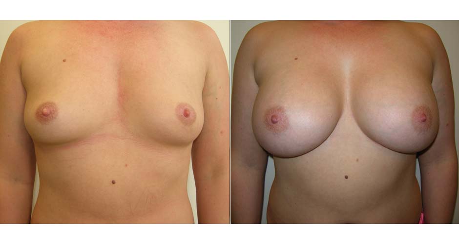 Breast Augmentation Before & After Photo