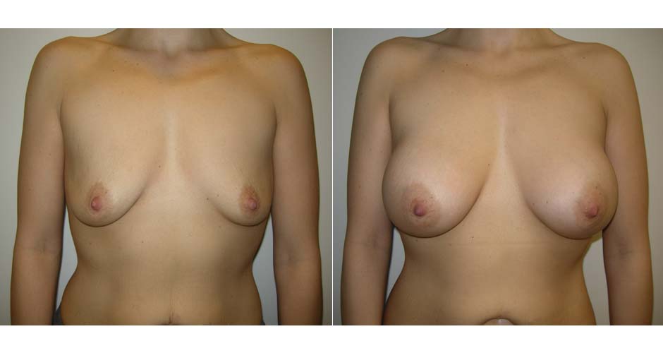 Breast Augmentation Before & After Photo