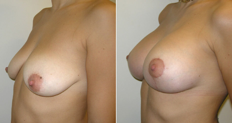 Breast Lift Before & After Photo