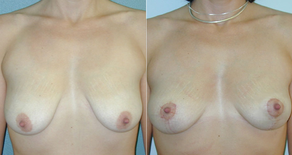 Breast Lift Before & After Photo