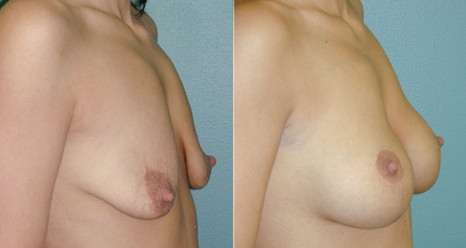 Breast Lift Before & After Photo