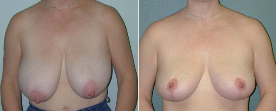 Breast Reduction Before & After Photo