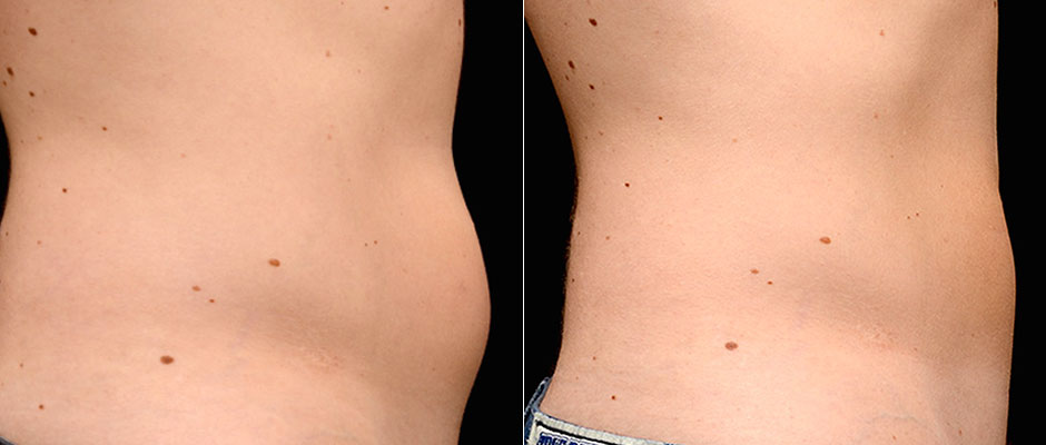 CoolSculpting for Men Before & After Photo