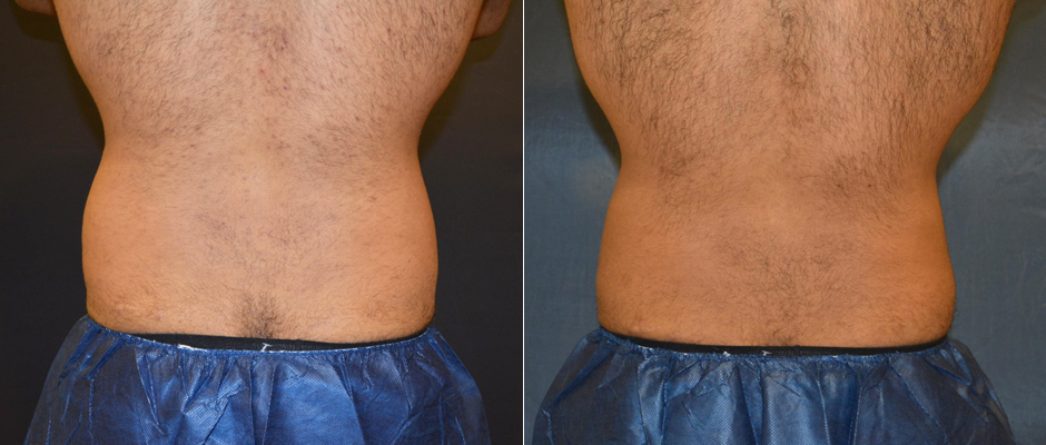 CoolSculpting for Men Before & After Photo