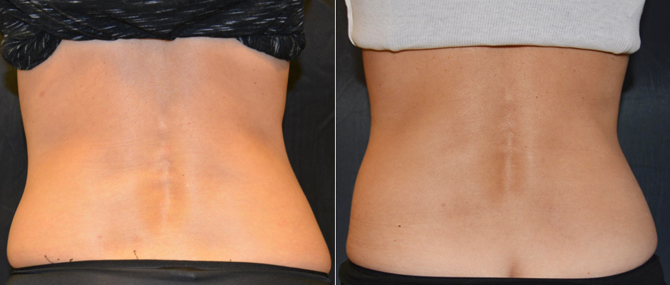 CoolSculpting for Women Before & After Photo