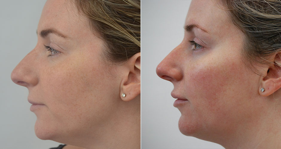 Dermal Fillers Before & After Photos