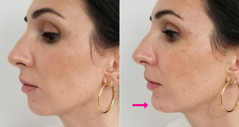 Dermal Fillers Before & After Photos