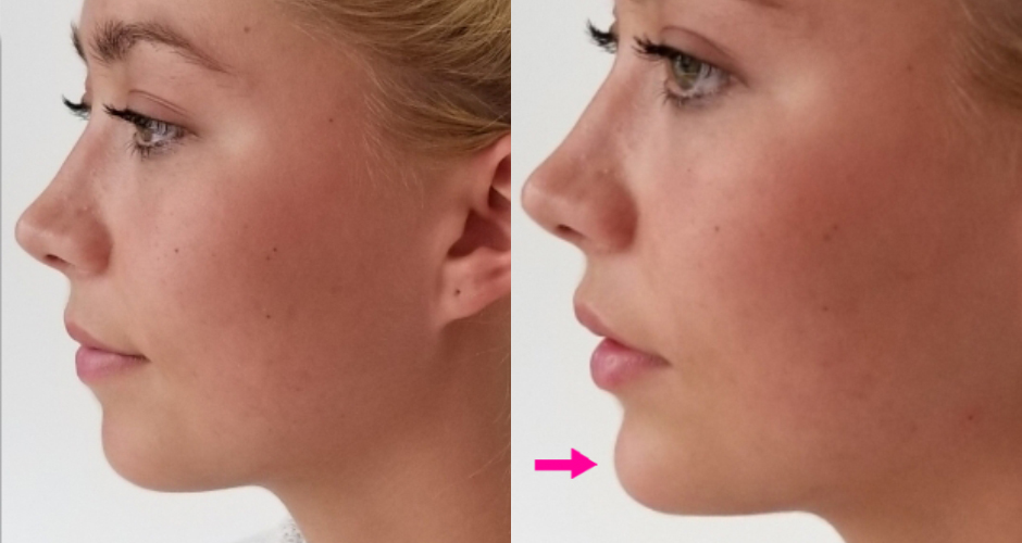 Dermal Fillers Before & After Photos