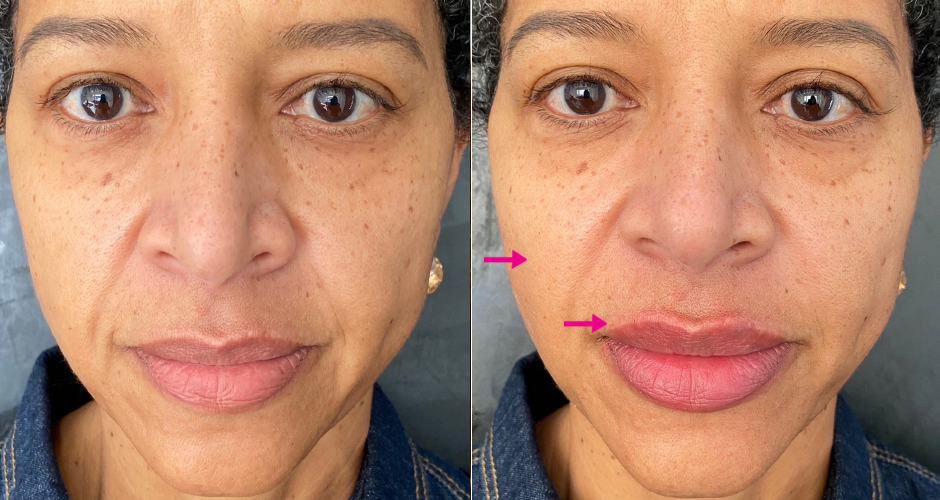 Dermal Fillers Before & After Photos