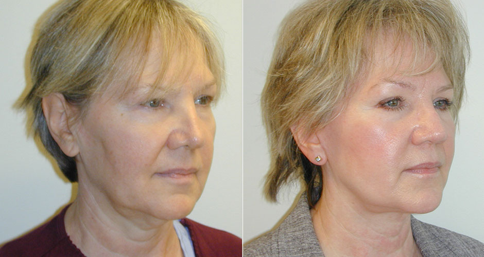 Face Lift Before & After Photo