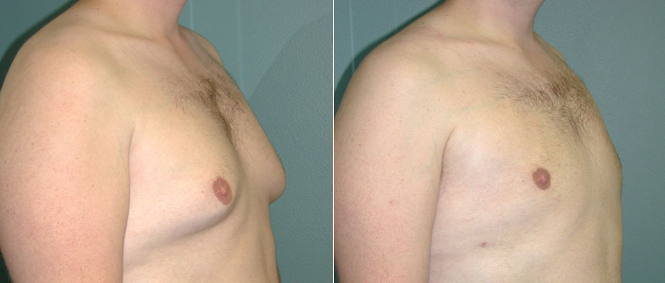 Gynecomastia Before & After Photo