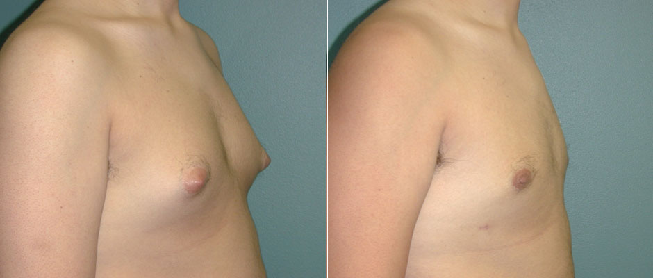 Gynecomastia Before & After Photo