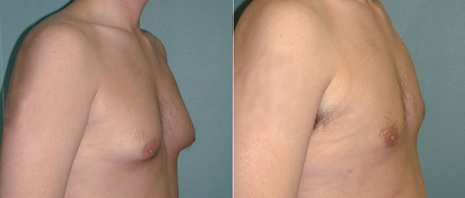 Gynecomastia Before & After Photo