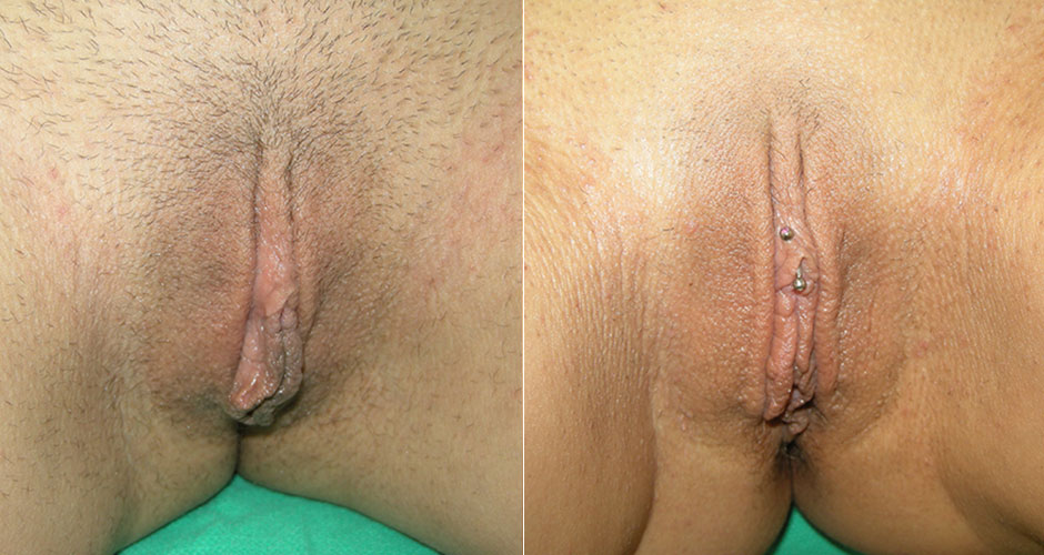 Labiaplasty Before & After Photo