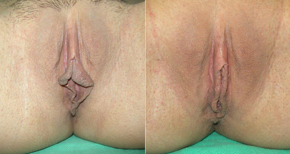 Labiaplasty Before & After Photo