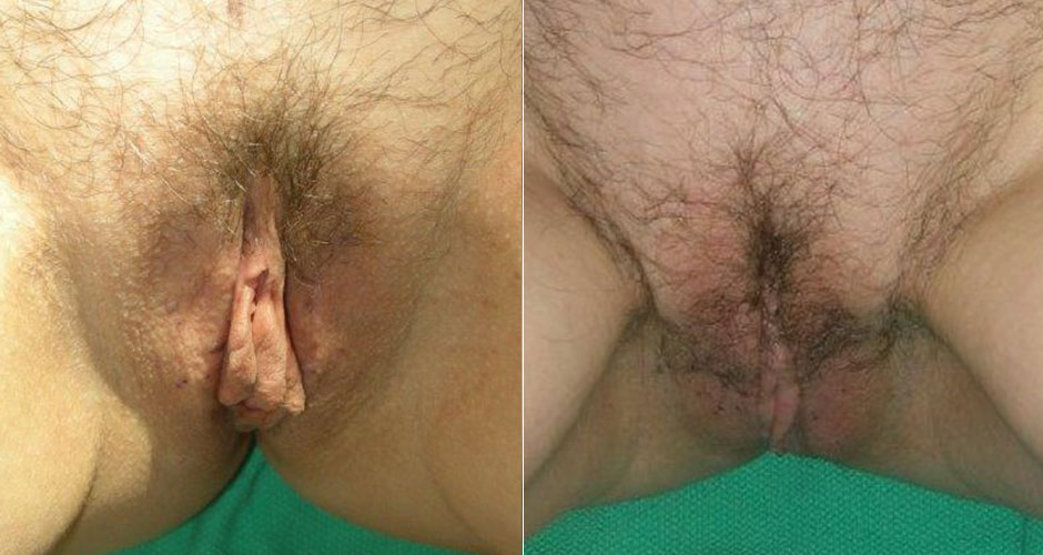 Labiaplasty Before & After Photo