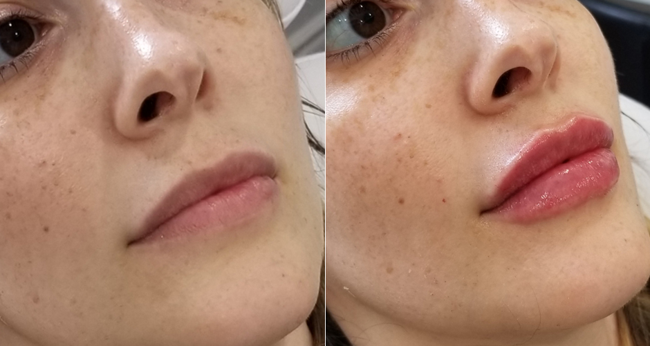 Lip Injection Before and After