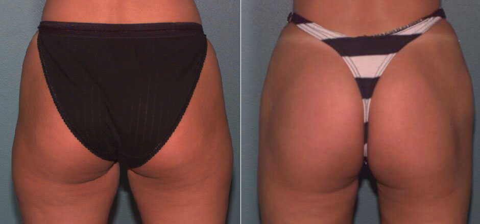 Liposuction Before & After Photo