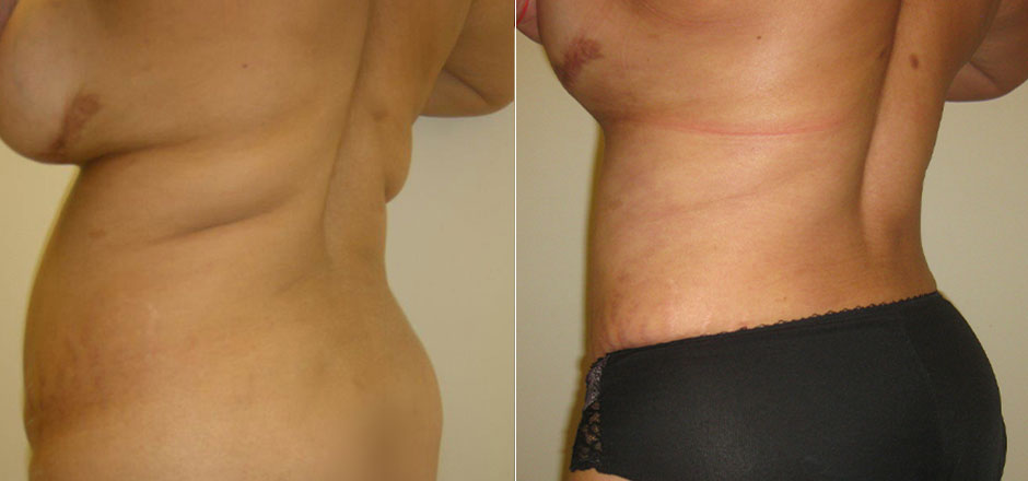 Liposuction Before & After Photo