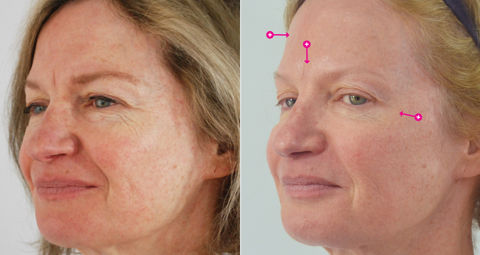 Injections for Wrinkles Before & After Photo