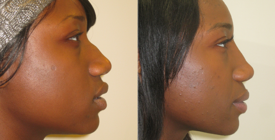 Rhinoplasty Before and After Photos