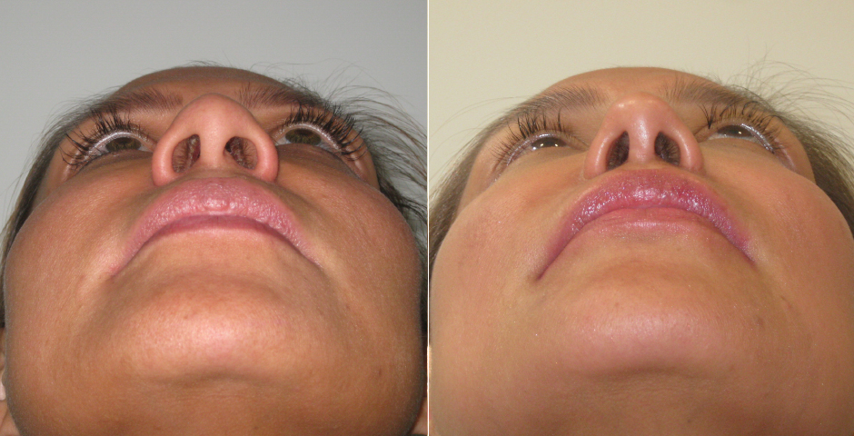 Rhinoplasty Before and After Photos