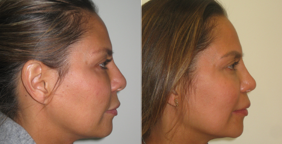 Rhinoplasty Before and After Photos