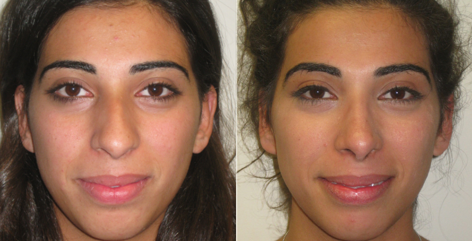 Rhinoplasty Before and After Photos