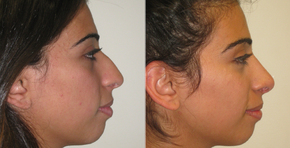 Rhinoplasty Before and After Photos