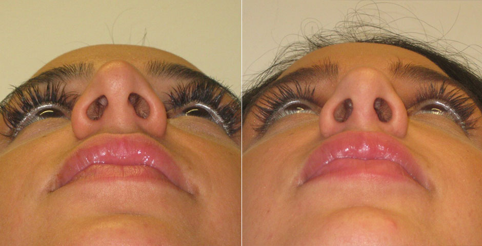 Rhinoplasty Before & After Photo