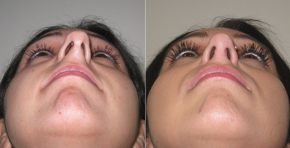 Rhinoplasty Before & After Photo