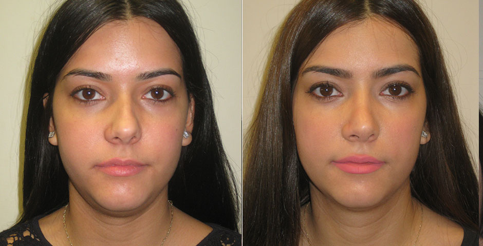 Rhinoplasty Before & After Photo