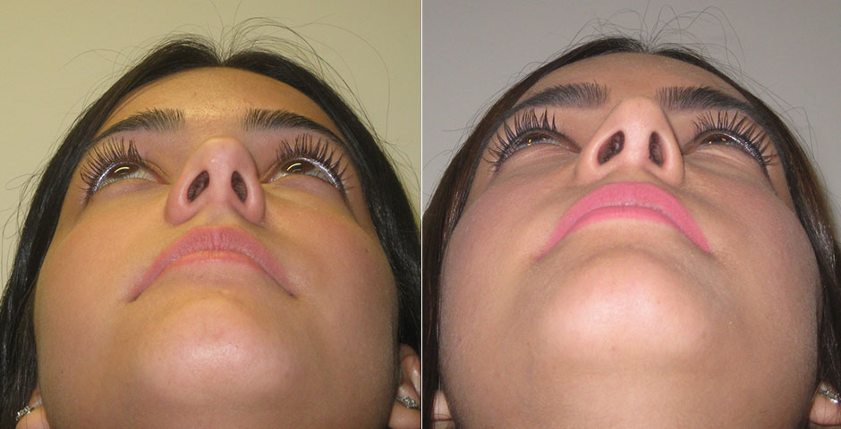 Rhinoplasty Before & After Photo